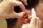 Acupunture Therapy